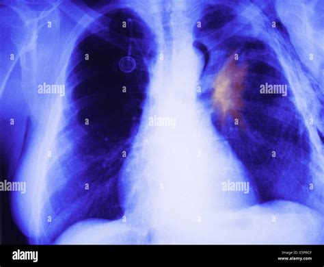 Emphysem Copd Fotos Und Bildmaterial In Hoher Aufl Sung Seite Alamy