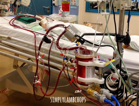 All about K: Our ECMO survivor! - Simply Lambchops