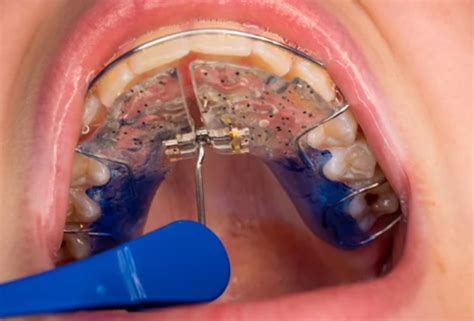 How To Tighten Retainer Oc Dental Center