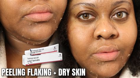 Rice Water Face Before and After: See the Shocking Results of This ...