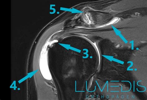 Schleimbeutelentz Ndung Lumedis Ihre Orthop Den