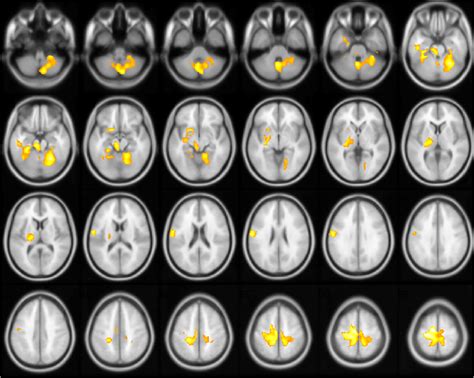 Correlation Between Brain Metabolism And Lockdown Duration Using Group Download Scientific