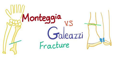 Galeazzi Fracture