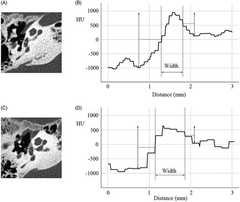 Measurement of stapes footplate thickness. (A) Normal control. Line in ...