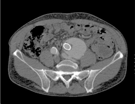 Figure 1 From Isolated Common Iliac Aneurysm And Spontaneous Ilioiliac