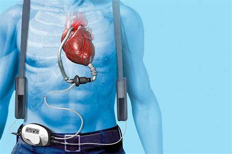 How LVAD Overcomes Heart Failure - Mazing US