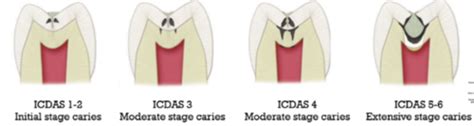 Caries Risk assessment Flashcards | Quizlet