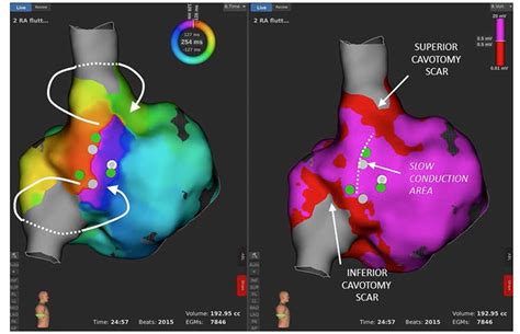 Case Report Usefulness Of High Resolution Mapping With Mini Electrodes