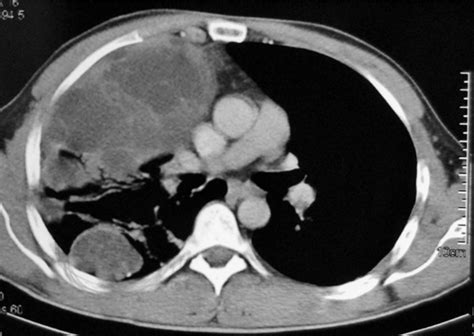 Full Text Pleuropulmonary Blastoma In An Adult A Case Report