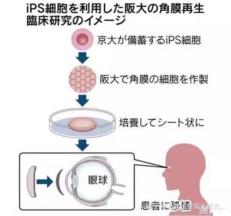 日本实施全球首例ips细胞角膜移植手术 知乎