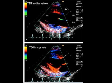 Echo Assessment Of Lv Systolic Function And Swma