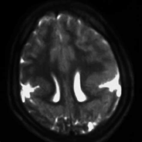 Pdf Bilateral Perisylvian Syndrome A Case Report