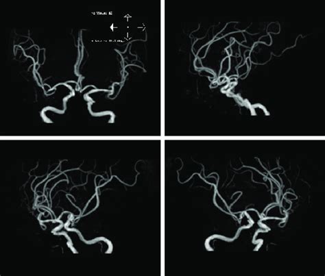 Magnetic Resonance Angiography Mra Suggested Atherosclerosis And No Download Scientific