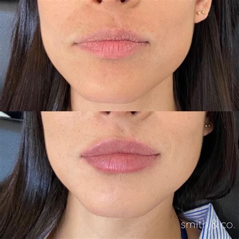 Half Or Full Syringe When It Comes To Lips Which Is Best — Danielle