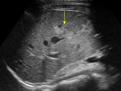 Wk 2 Liver Pathology Liver Rupture With A Hyperechoic Hematoma