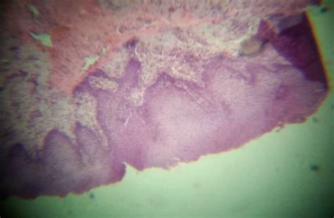 Histopathology Of Mucocele Showing Mucosal Epithelium Beneath It