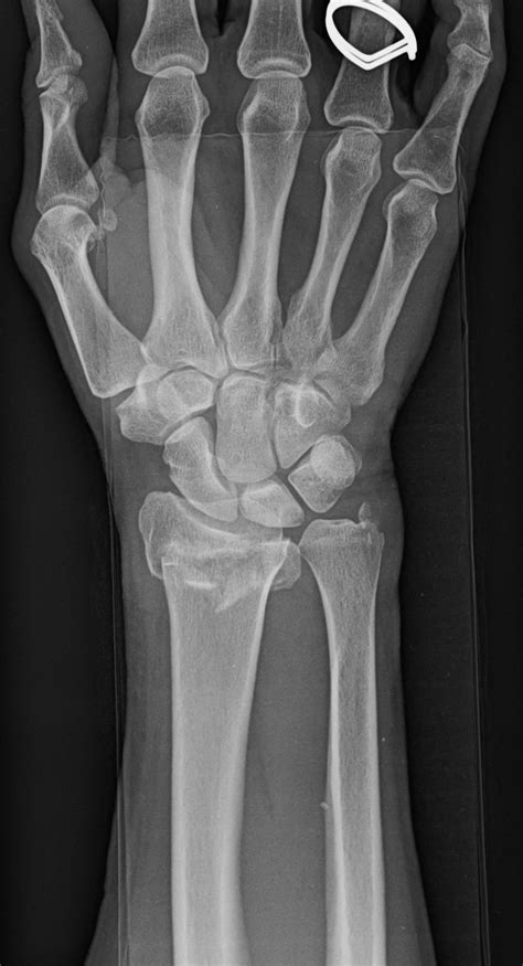 Broken Wrist Treatment in Raleigh, NC - John Erickson, MD