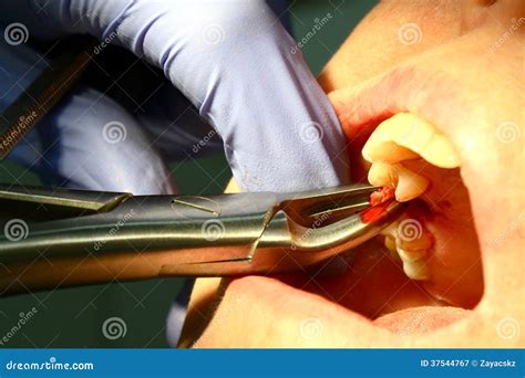 Molar Tooth Extraction With Dental Pliers Stock Image Image Of