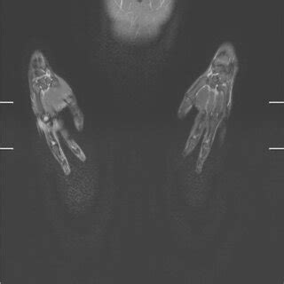 Whole-body MRI coronal short tau inversion recovery (STIR) composed ...