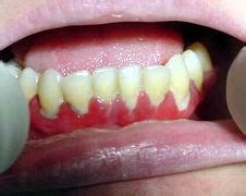 Que Es La Gingivitis Ulcerativa Gingivitis Ulceronecrotizante Aguda