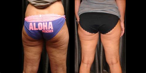 Before And After Cellulite Reduction By Dr Nwizu