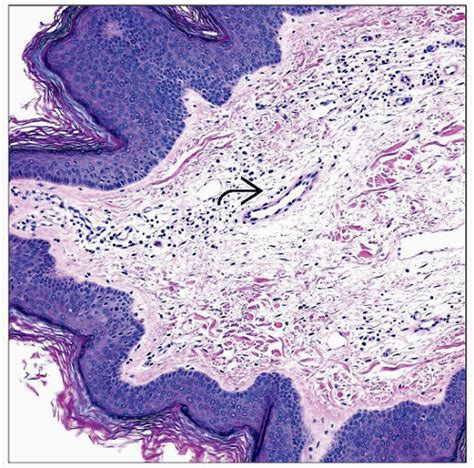 Fibroepithelial Polyps Acrochordons Basicmedical Key