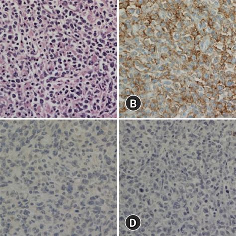 Histologic Features And Immunohistochemical Findings Of Primary