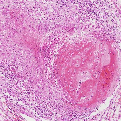 Several Epithelioid Granulomas In The Clear Cell Renal Cell Carcinoma Download Scientific Diagram