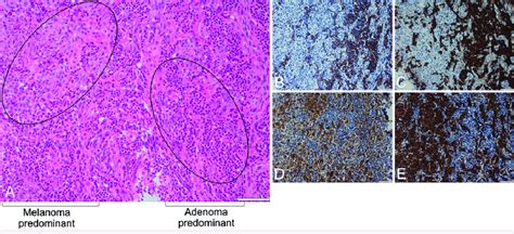 A Hematoxylin And Eosin Staining Of Tumor Specimen Area Depicting Both