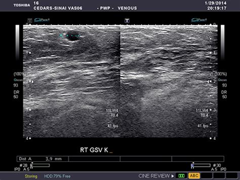 Vein Mapping Ultrasound Legs