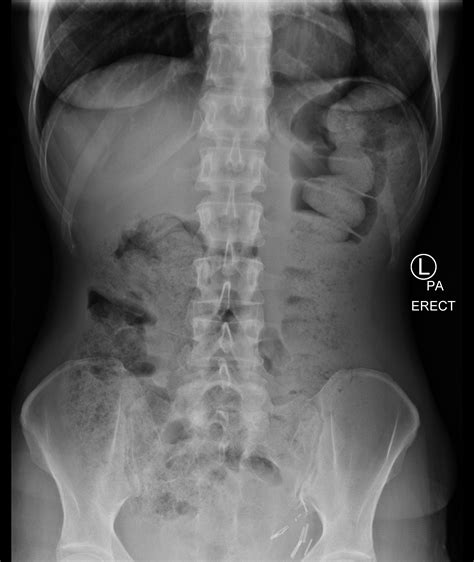 Abdomen X Ray
