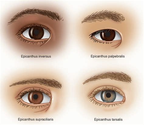 Epicanthal Fold Repair Ento Key