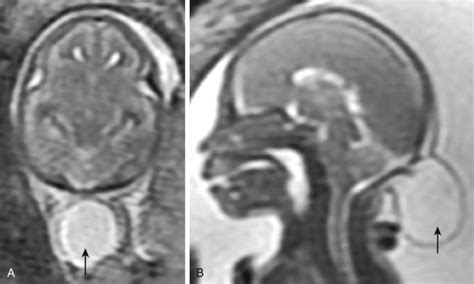 Neural Tube Development Neupsy Key