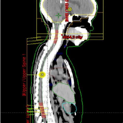 Fig1. Cervical junction and lumbar junction were determined as the ...