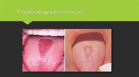 Аномалии и самостоятельные заболевания языка. Хронические ...