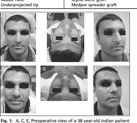 Figure 1 From Open Septorhinoplasty Operative Technique And Grafts