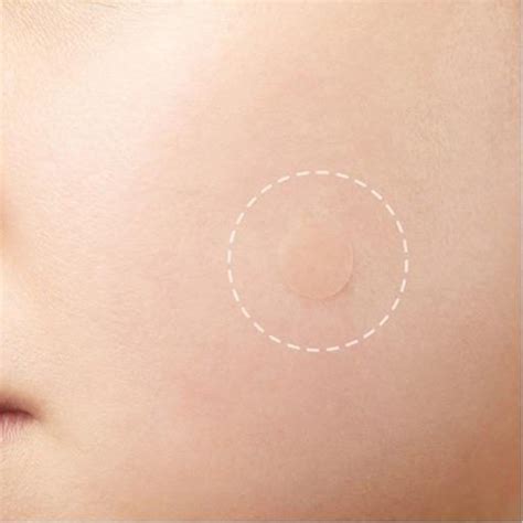 8 Things I Love About This Acne Patch Set ! - Biotyful.net