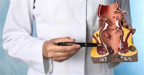 Anal Hematom Tedavisi Idea Klinik