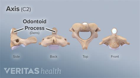 Neck Pain From Crowned Dens Syndrome