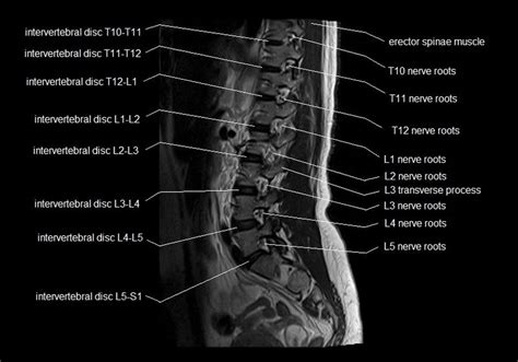 Lumbar Spine Sagittal