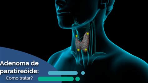 Adenoma De Paratire Ide Como Tratar Dr Rafael De Cicco