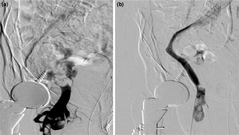 Venography Findings From Before And After Endovascular Repair Of