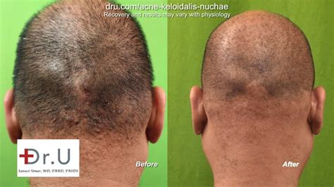 Dr U’s Selective Treatment Approach For Acne Keloidalis Nuchae Laser Treatment Dr U Hair