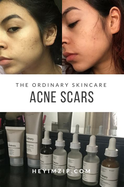 The Ordinary Skincare For Acne Scars U Know Whats