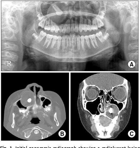 Figure 1 From Extensive Adenomatoid Odontogenic Tumor Of The Maxilla A