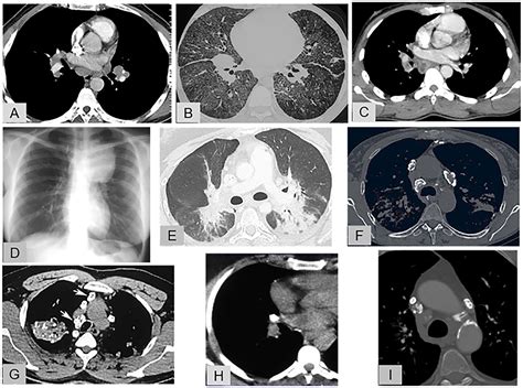 Per Quanto Riguarda Le Persone Spaventoso Termosifone Sarcoidosis Vasc