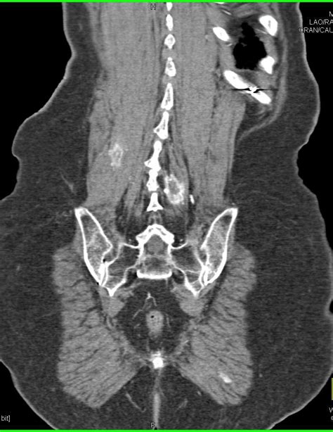 Vascular Muscle Metastases From Renal Cell Carcinoma Musculoskeletal