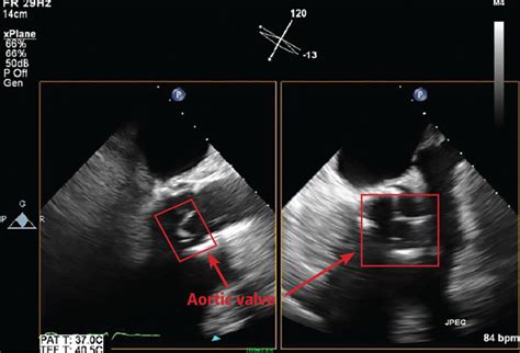 Infective Endocarditis Beyond The Usual Tests Cleveland Clinic