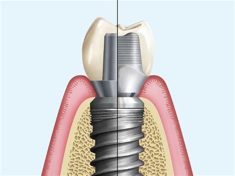 Implant Restorations Screw Retained Vs Cemented Crowns