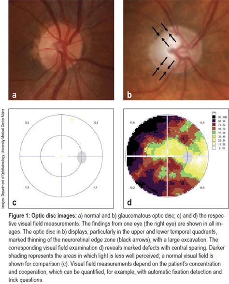 The Diagnosis And Treatment Of Glaucoma 27 03 2020